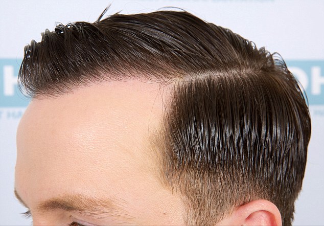 natural way to regrow bald hair